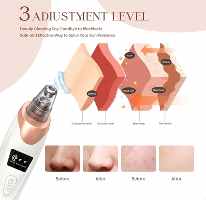 5-in-1 Electric Blackhead Remover Pore Vacuum